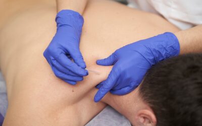 Dry needling for back pain: 4 top benefits