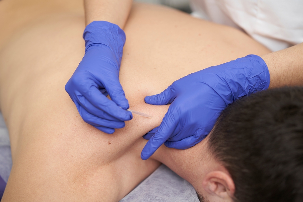 Dry needling near you: What you need to know