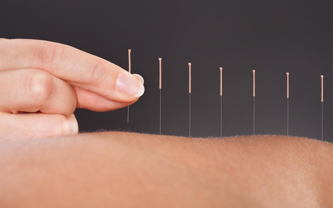 4 advantages acupuncture can provide to those trying to lose weight