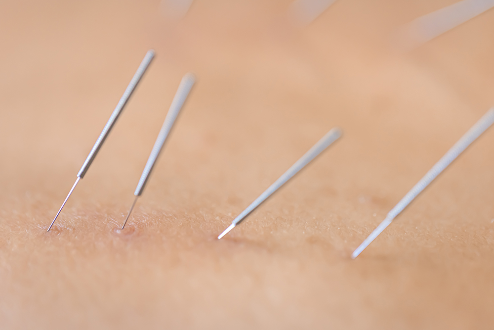 What are the pros and cons of dry needling?