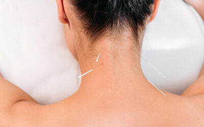 5 ways that dry needling can help trigger points